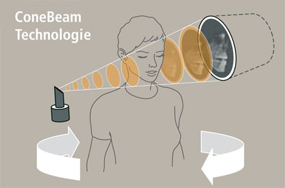 Grafik Cone-Beam-Technologie